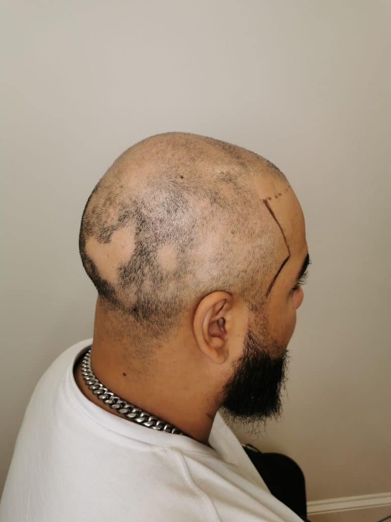 smp for alopecia